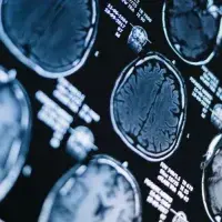 Amyloid‐beta‐targeting monoclonal antibodies for people with mild cognitive impairment or mild dementia due to Alzheimer’s disease