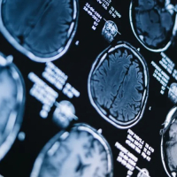 Amyloid‐beta‐targeting monoclonal antibodies for people with mild cognitive impairment or mild dementia due to Alzheimer’s disease